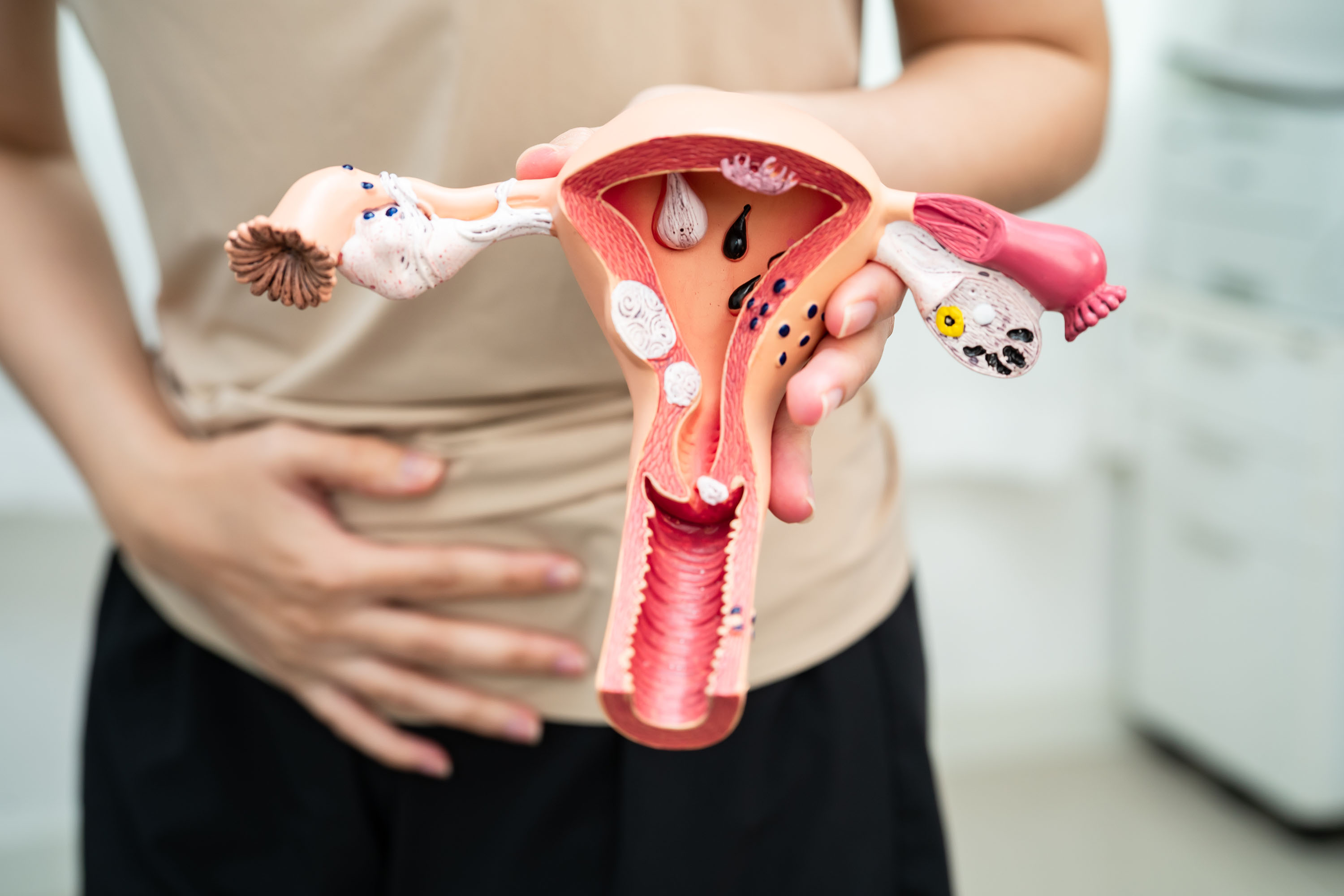Adenomyozis