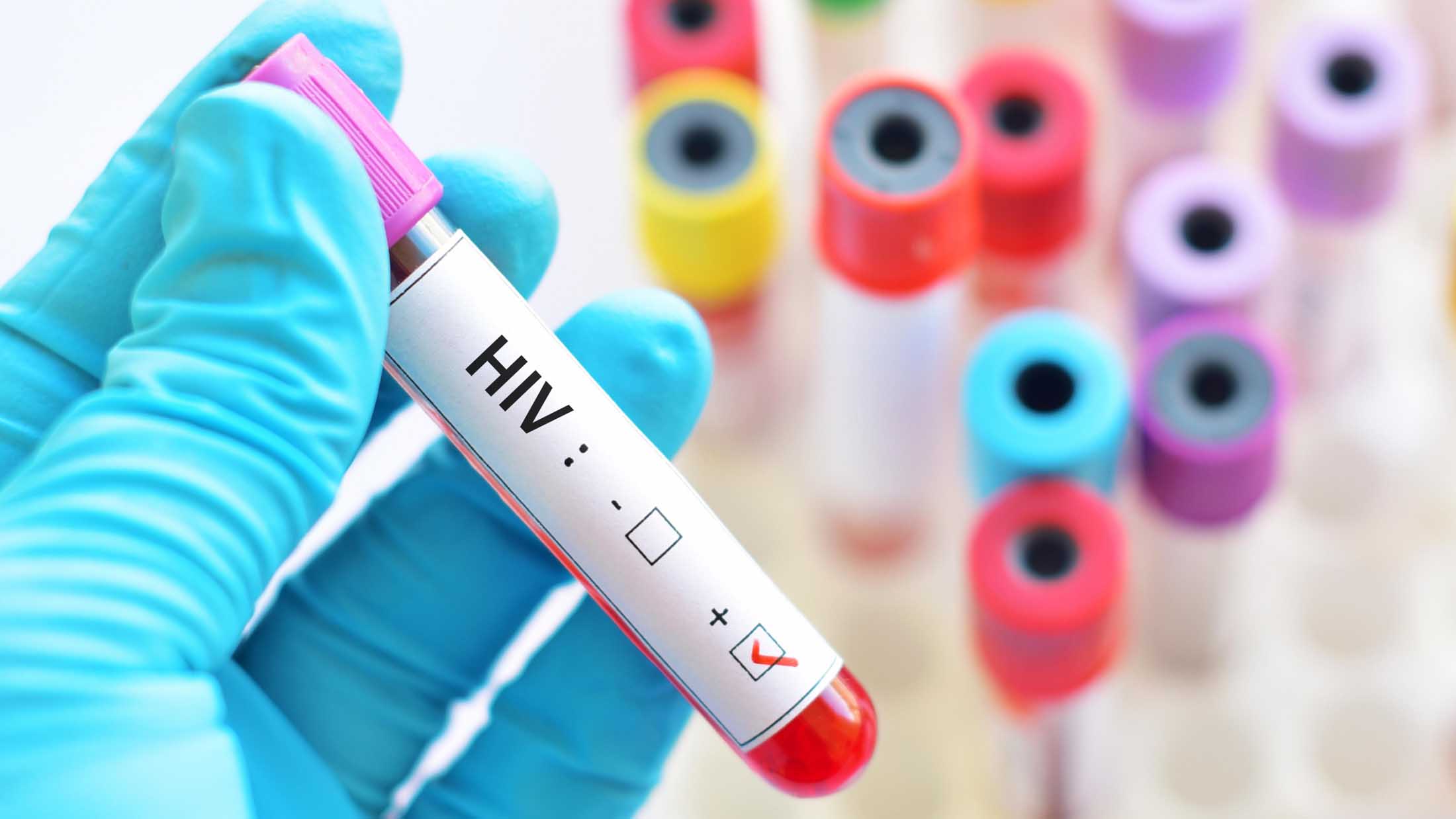 AIDS-HIV