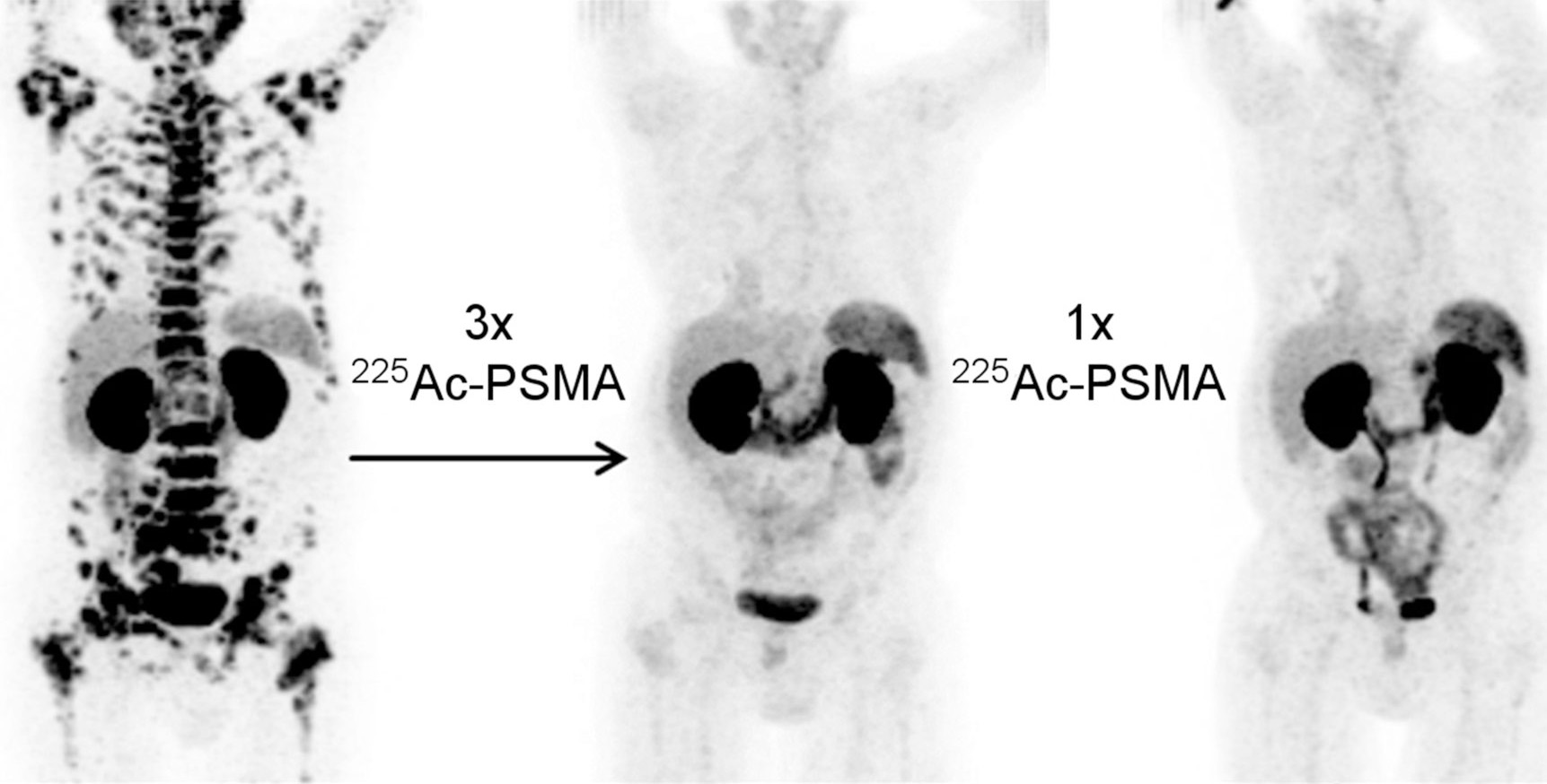 Aktinyum-225 ve Lutesyum-177 PSMA Tedavisi