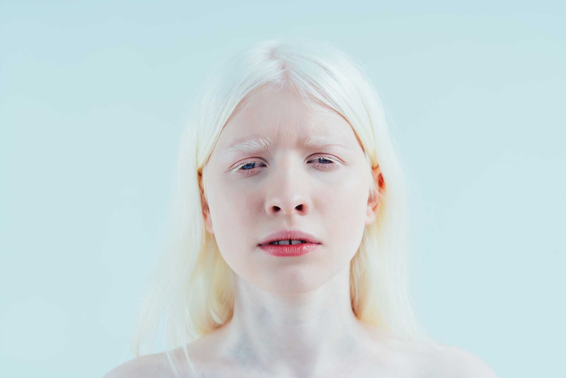 Albino (Albinizm)