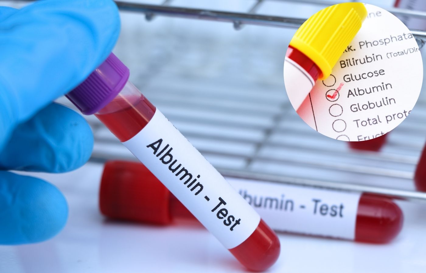 Albümin Testi