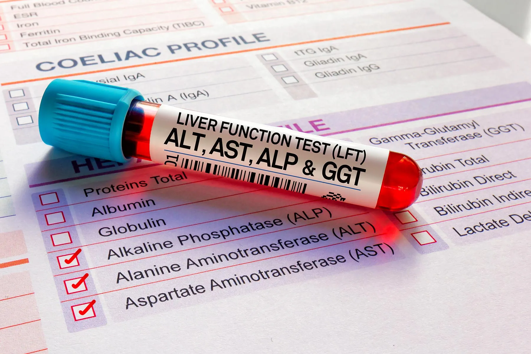 ALT (Alanin Aminotransferaz)