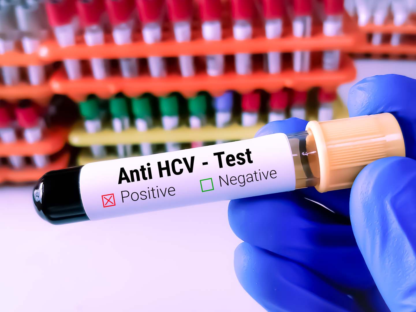 Anti HCV Testi