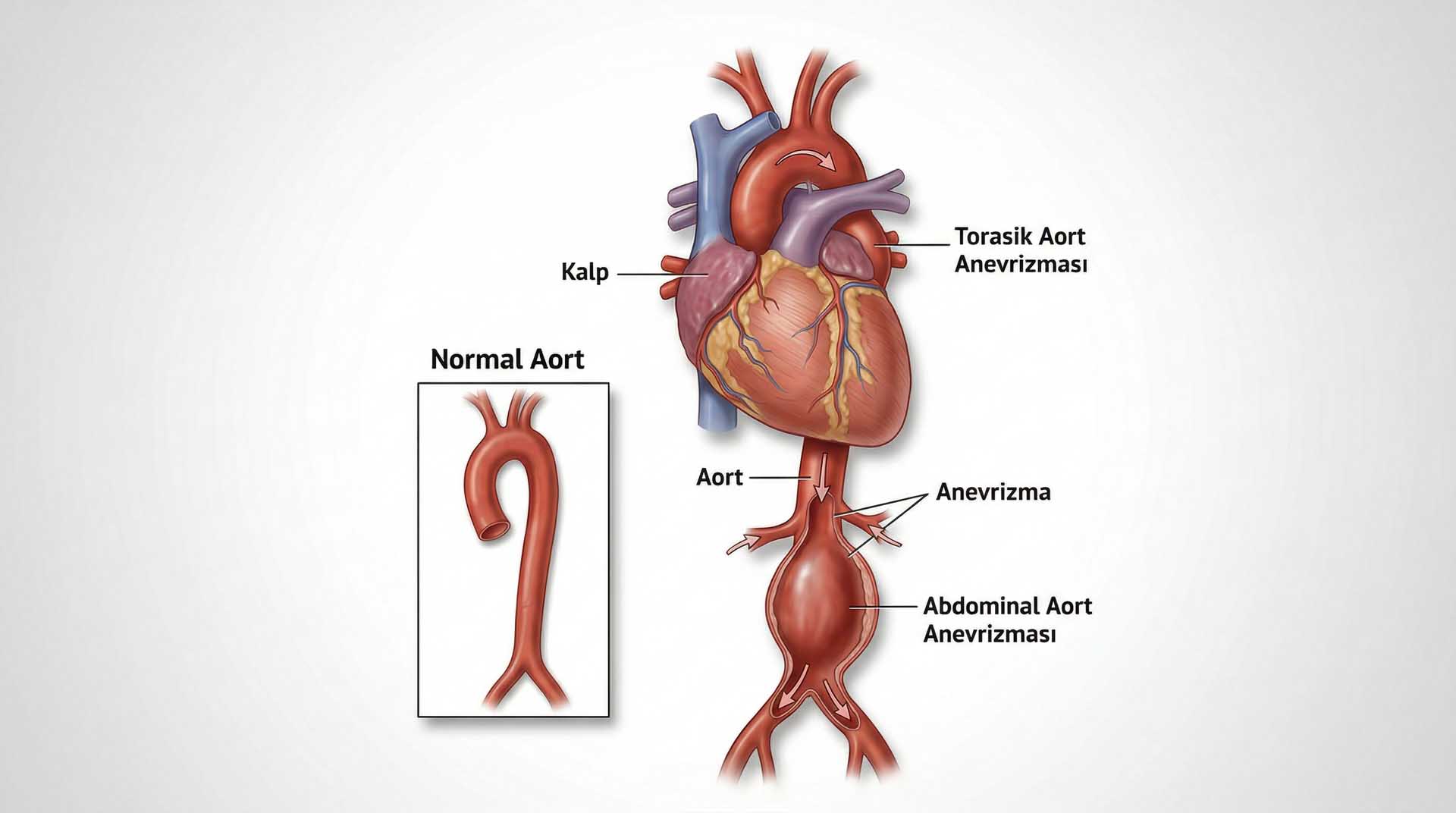 Aort Anevrizması