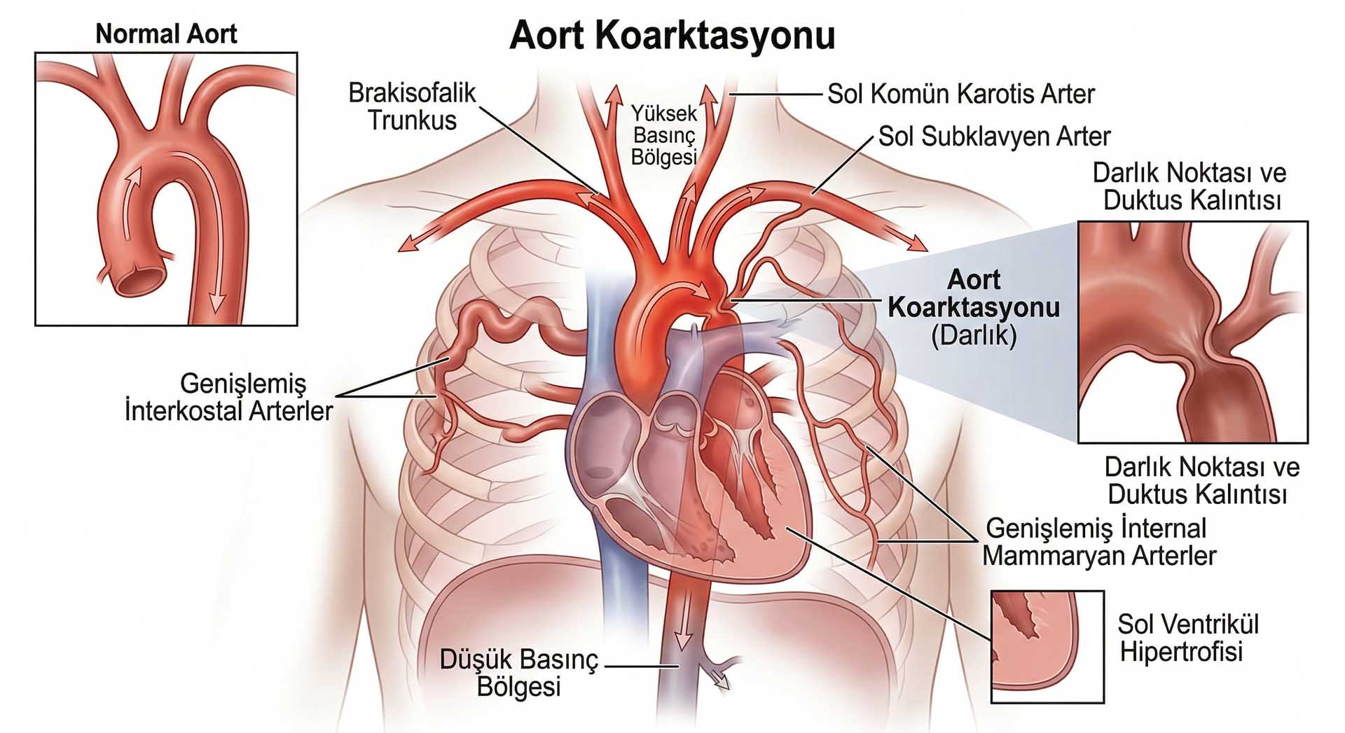 Aort Koarktasyonu