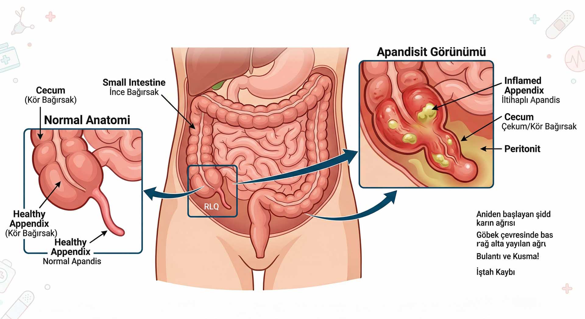 Apandisit