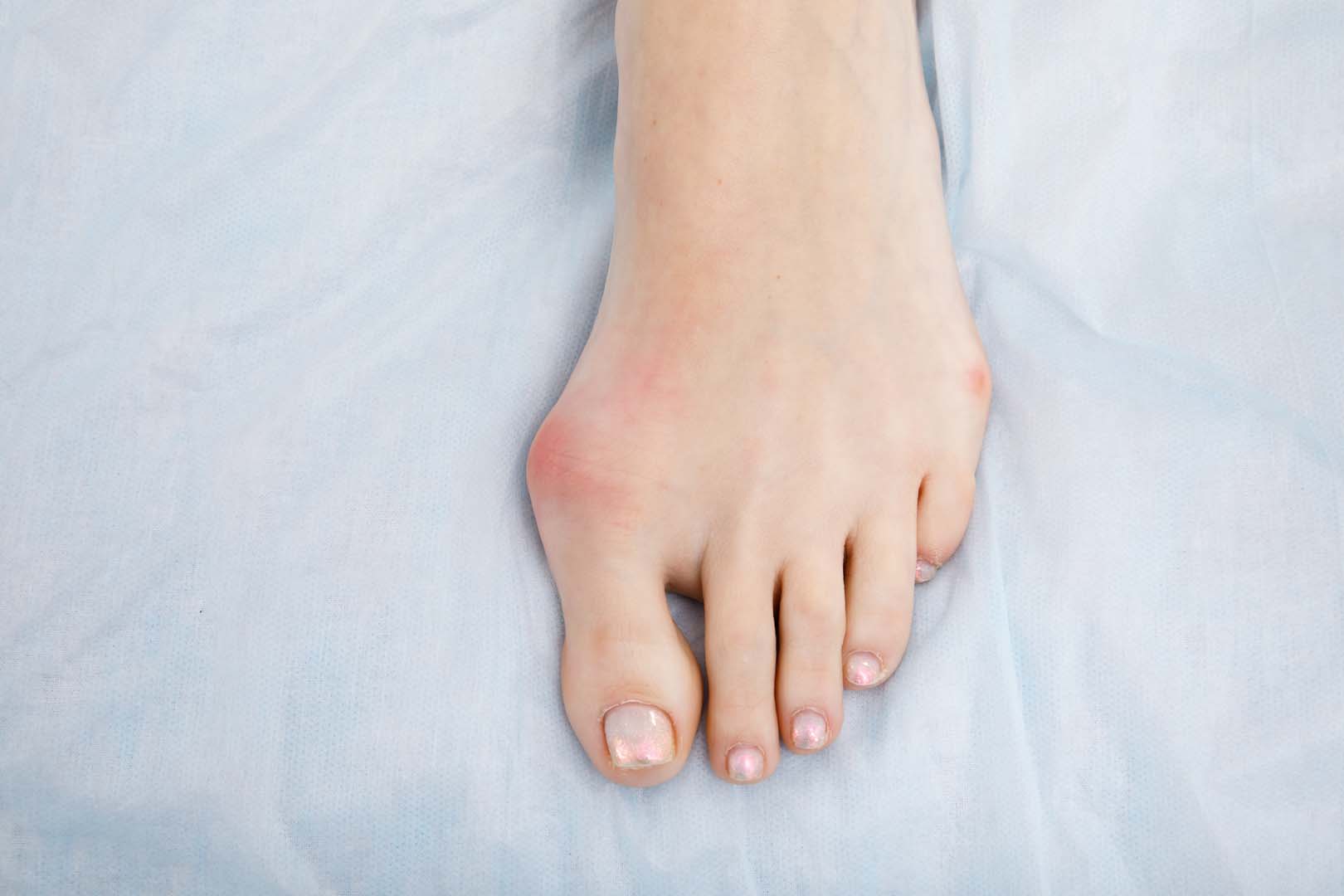 Başparmak Çıkıntısı (Halluks Valgus)