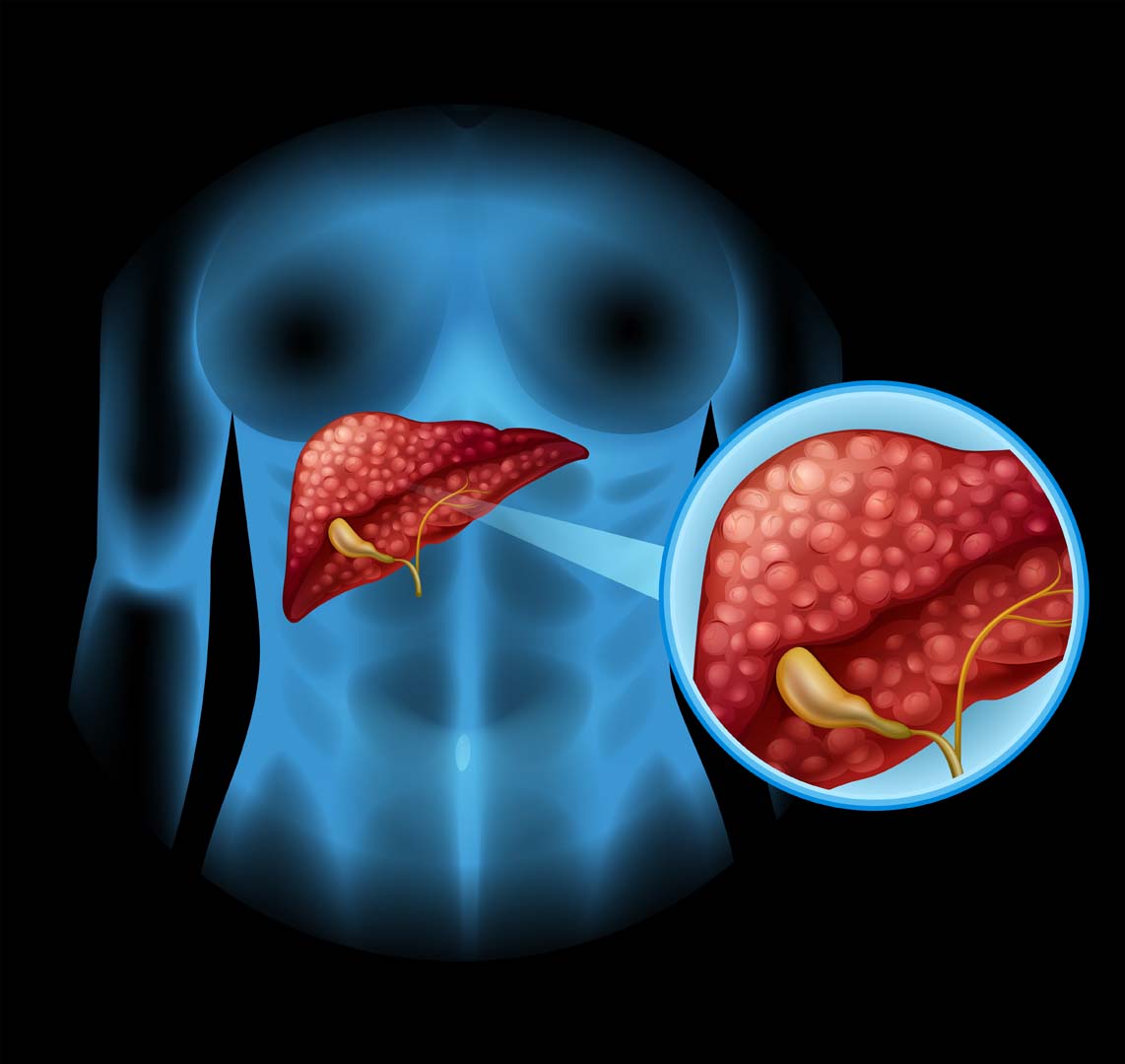 Bilirubin
