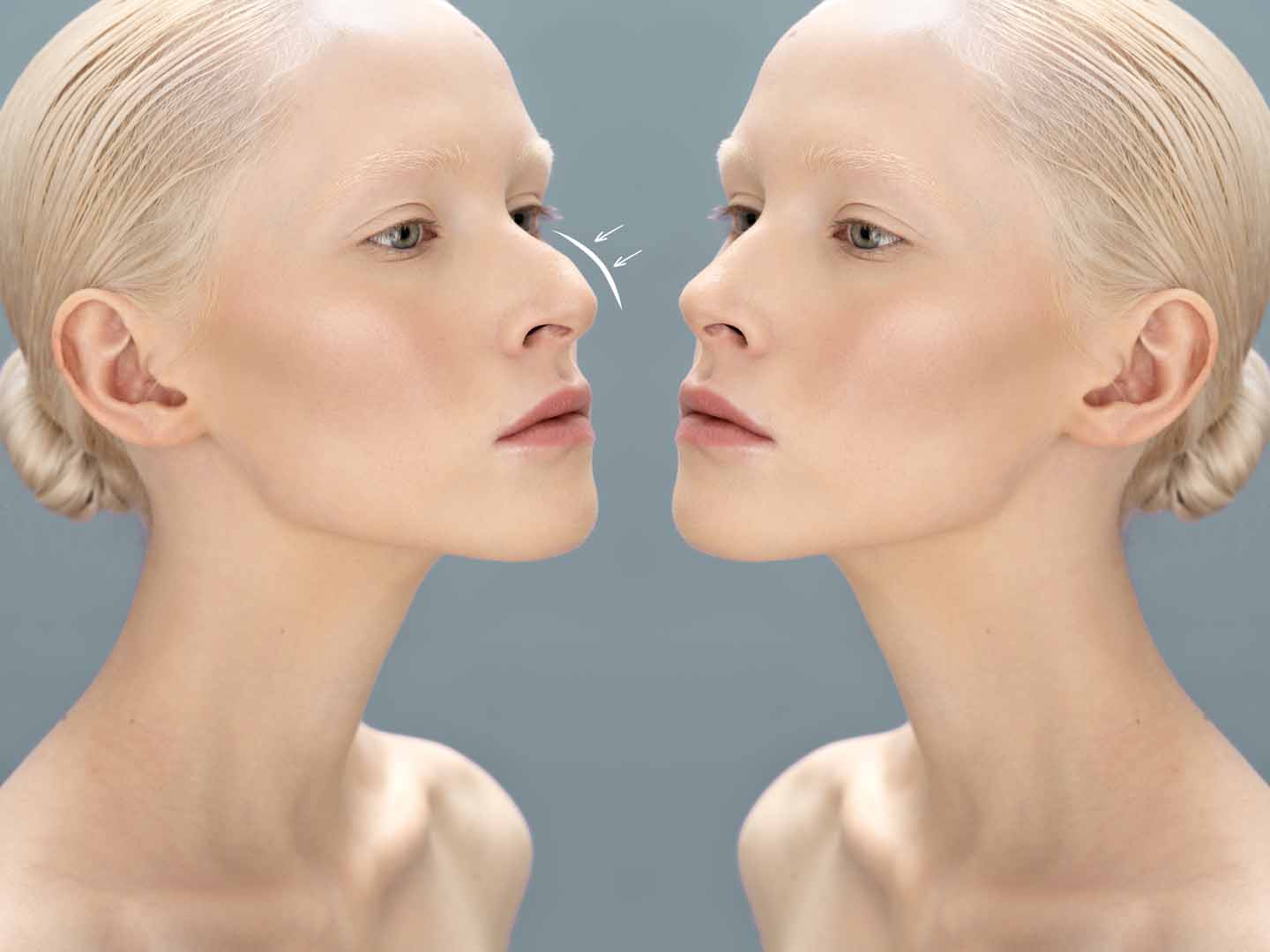 Burun Kemiği Eğriliği Ameliyatı (Septoplasti)