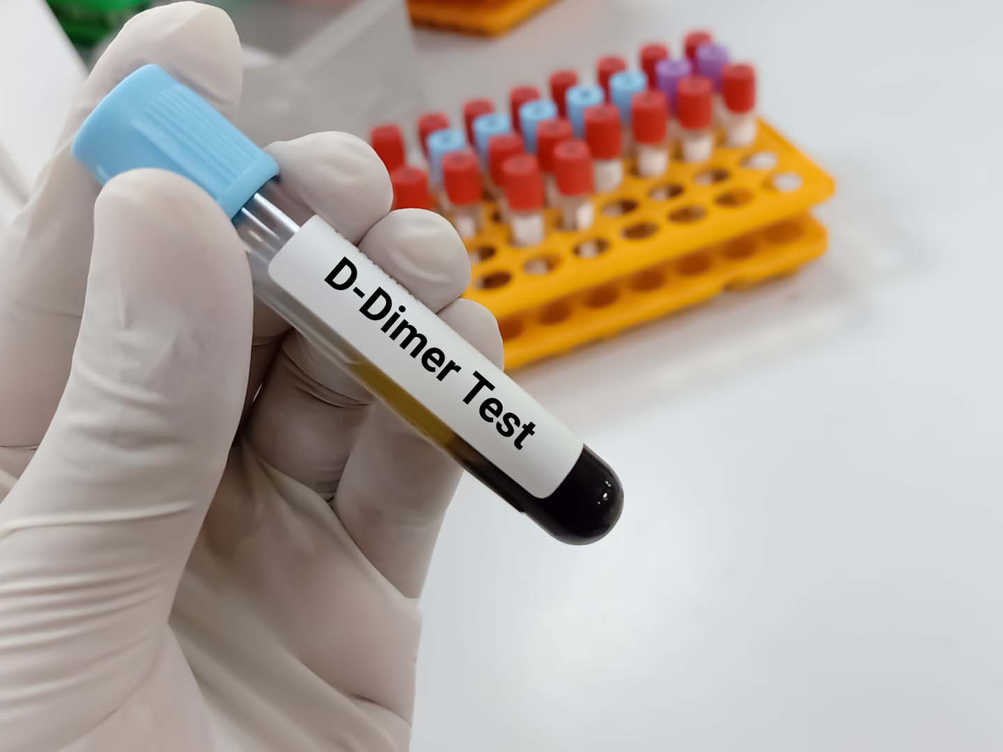 D Dimer Testi
