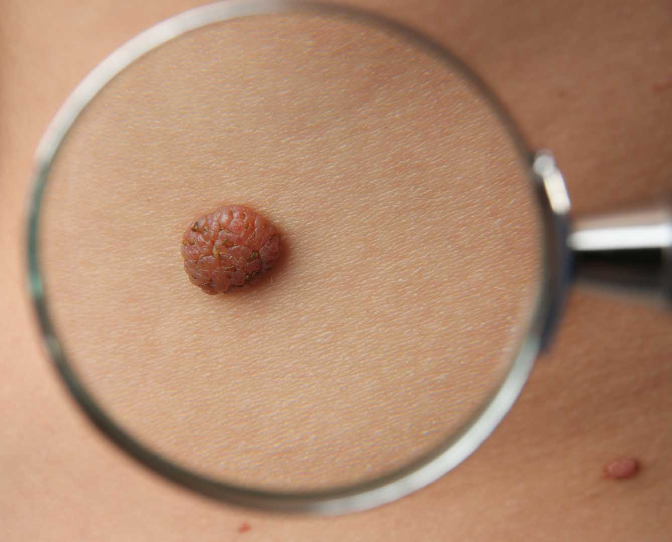 Dermoid Kist