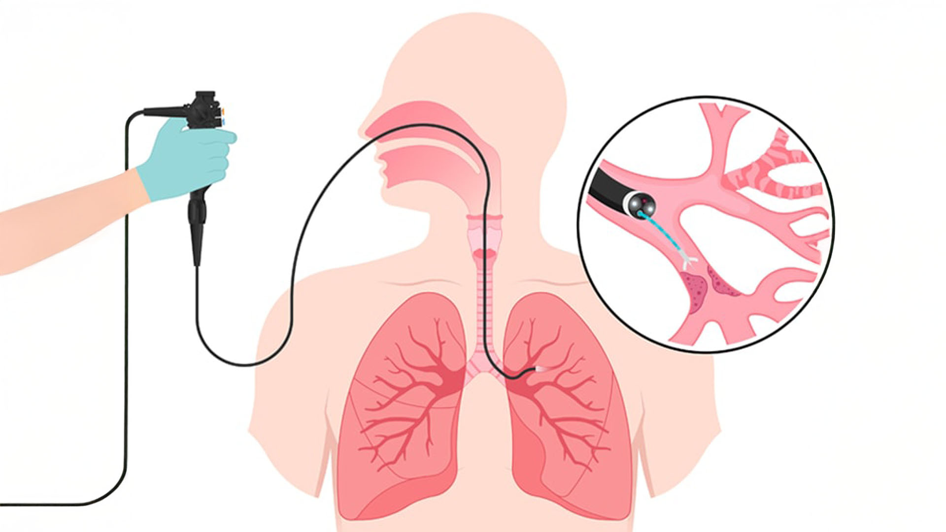 Endobronşiyal Ultrasonografi (EBUS)