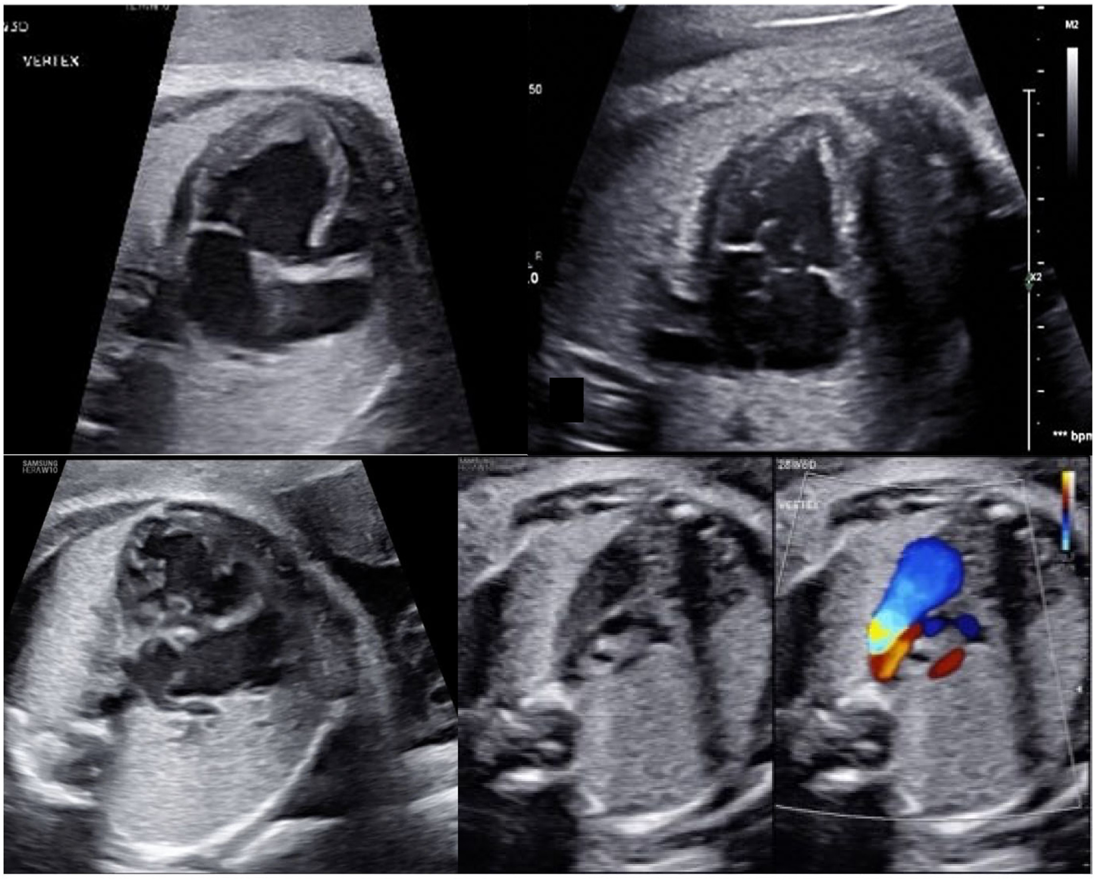 Fetal Ekokardiyografi