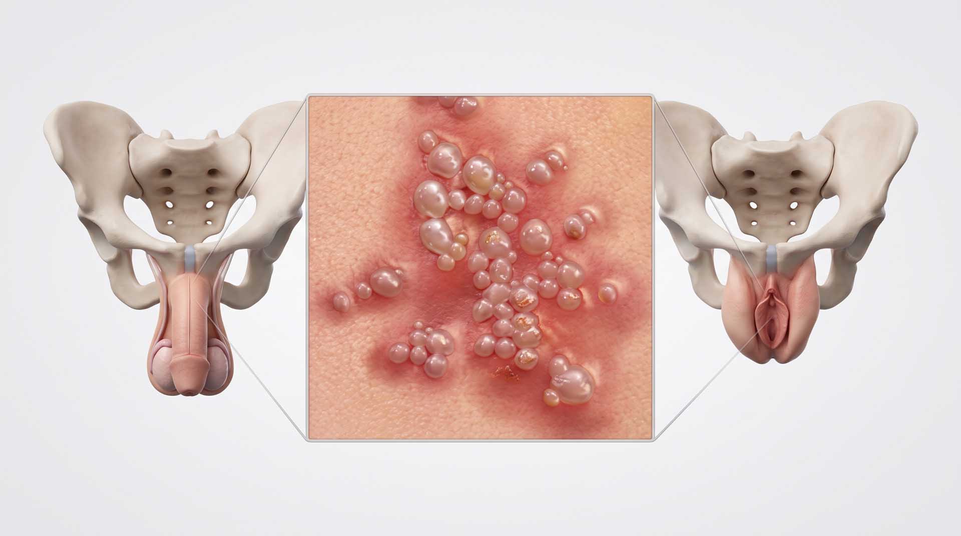Genital Uçuk (Herpes)