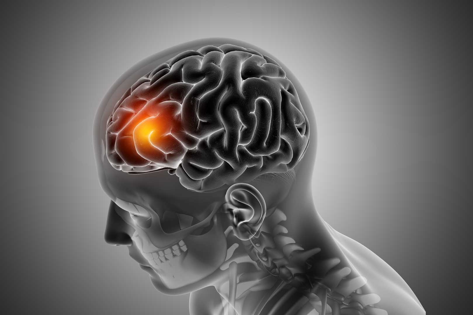 Glial Tümör