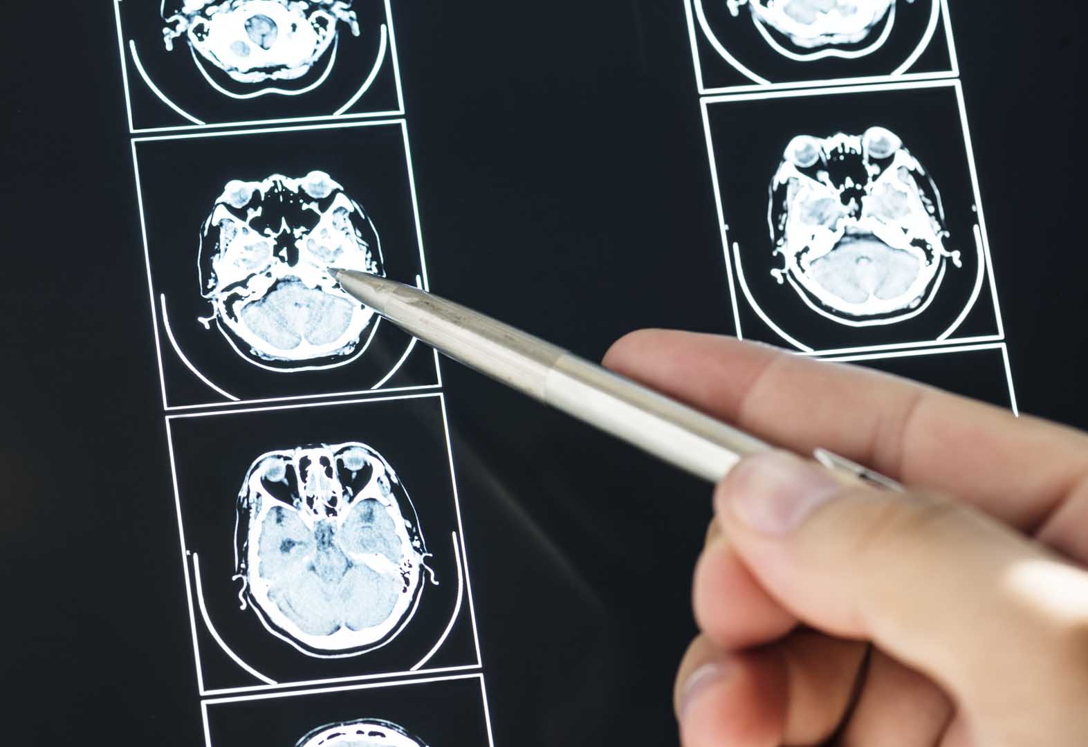 Glioblastoma