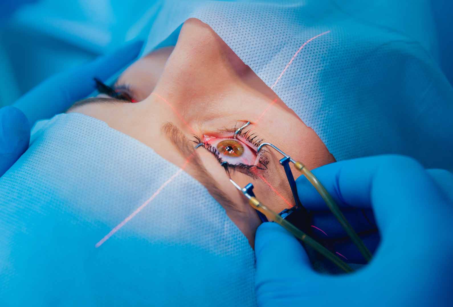 Göz Çizdirme Ameliyatı (Lazer/Lasik)