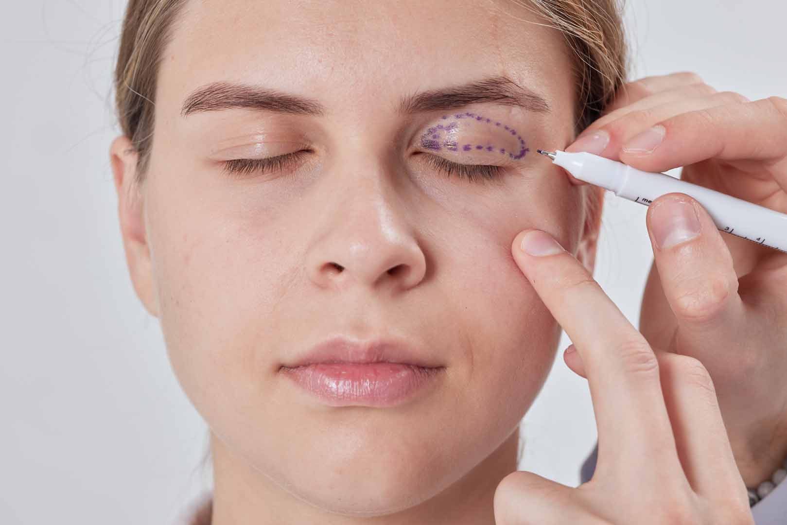 Göz Kapağı Estetiği (Blefaroplasti)