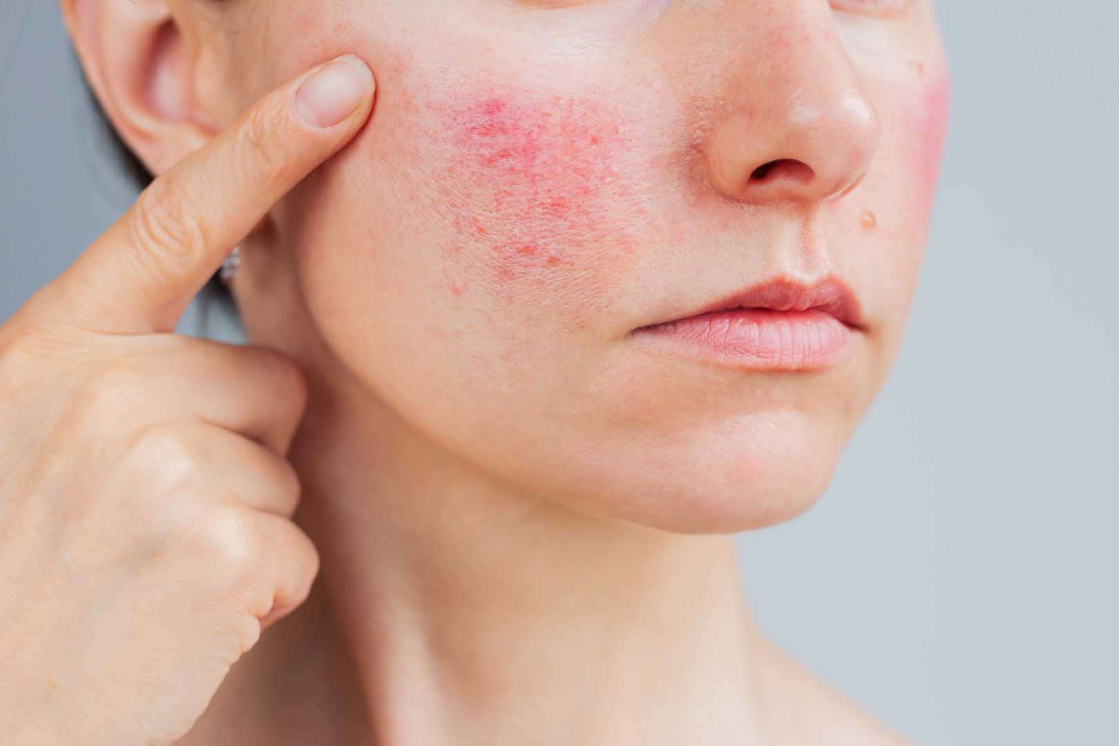 Gül Hastalığı (Rosacea)