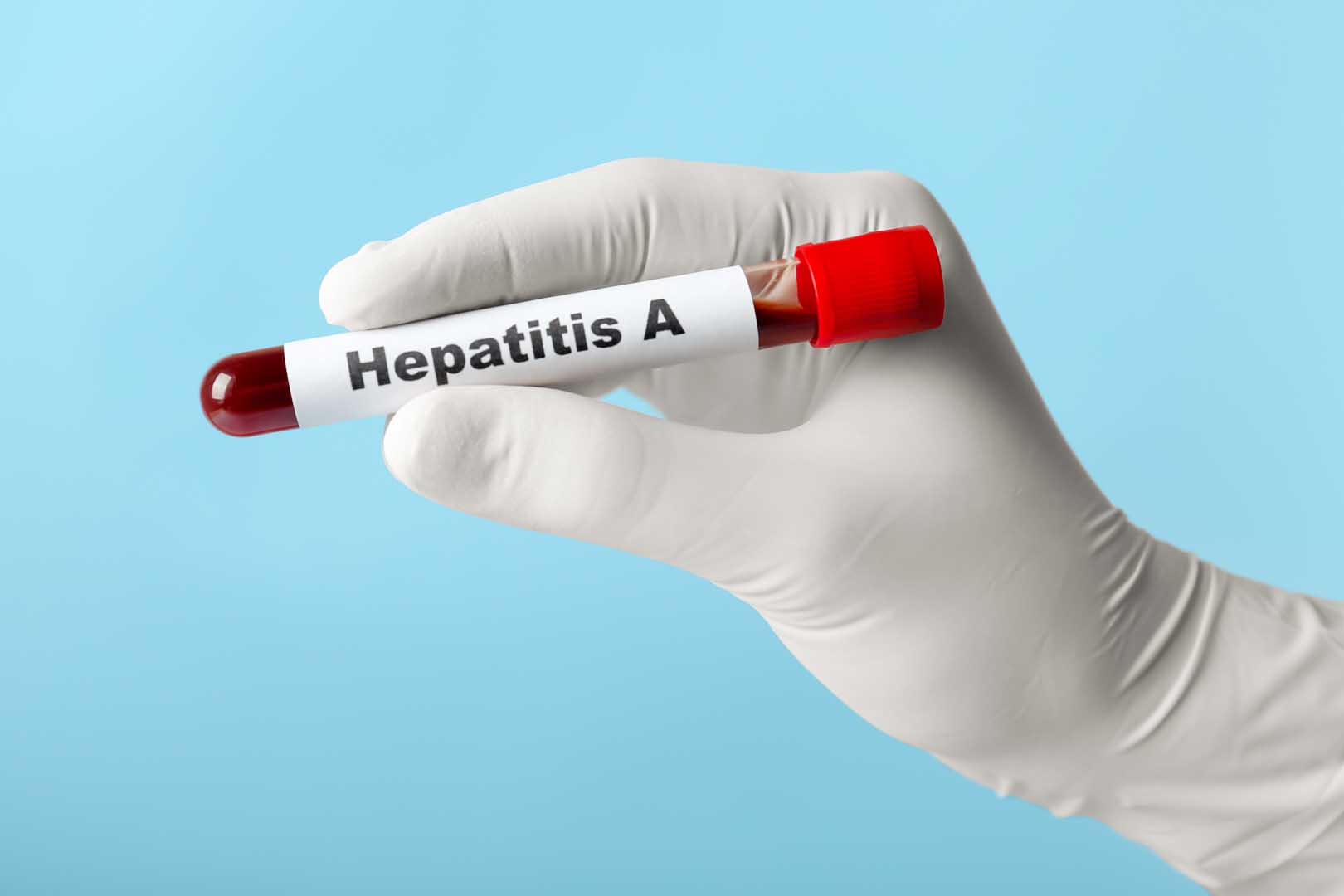 Hepatit A