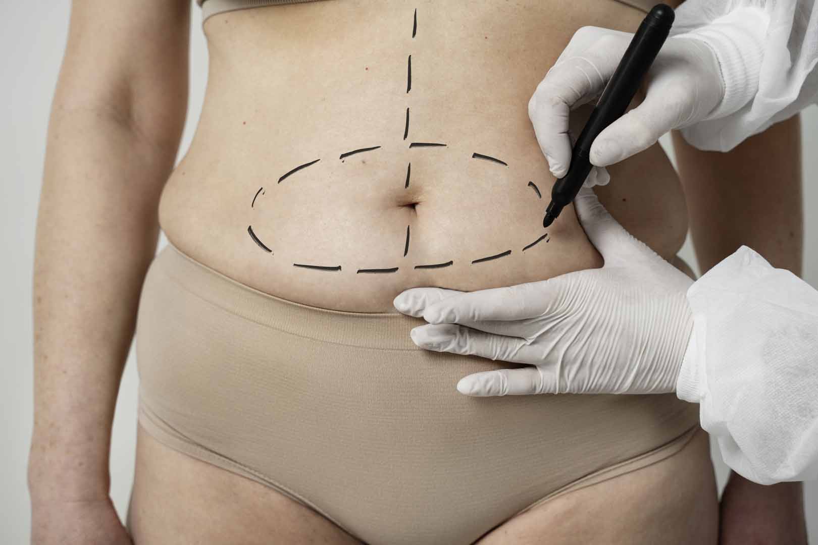 Karın Germe Ameliyatı (Abdominoplasti)