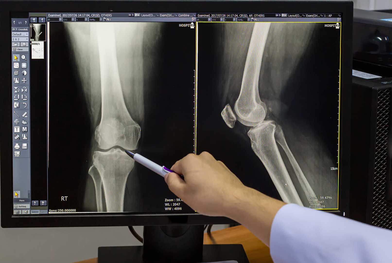 Kemik Kanseri (Osteosarkom)