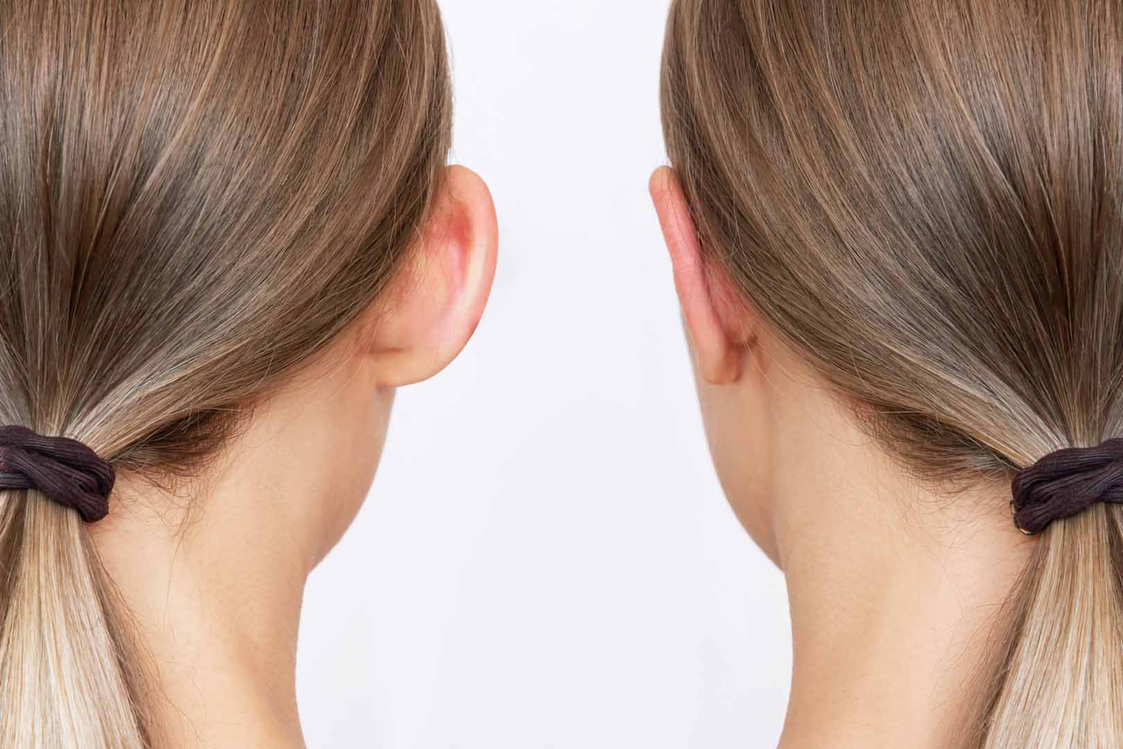 Kepçe Kulak Ameliyatı (Otoplasti)