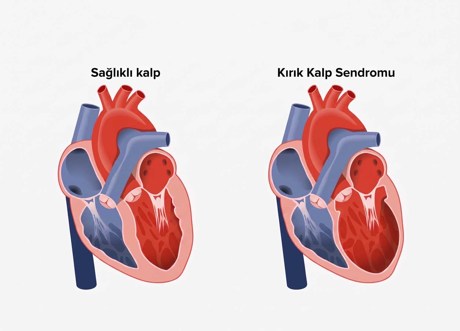 Kırık Kalp Sendromu