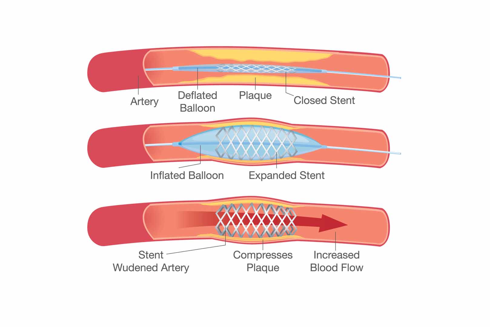 Koroner Anjiyoplasti (Balon ve Stent)