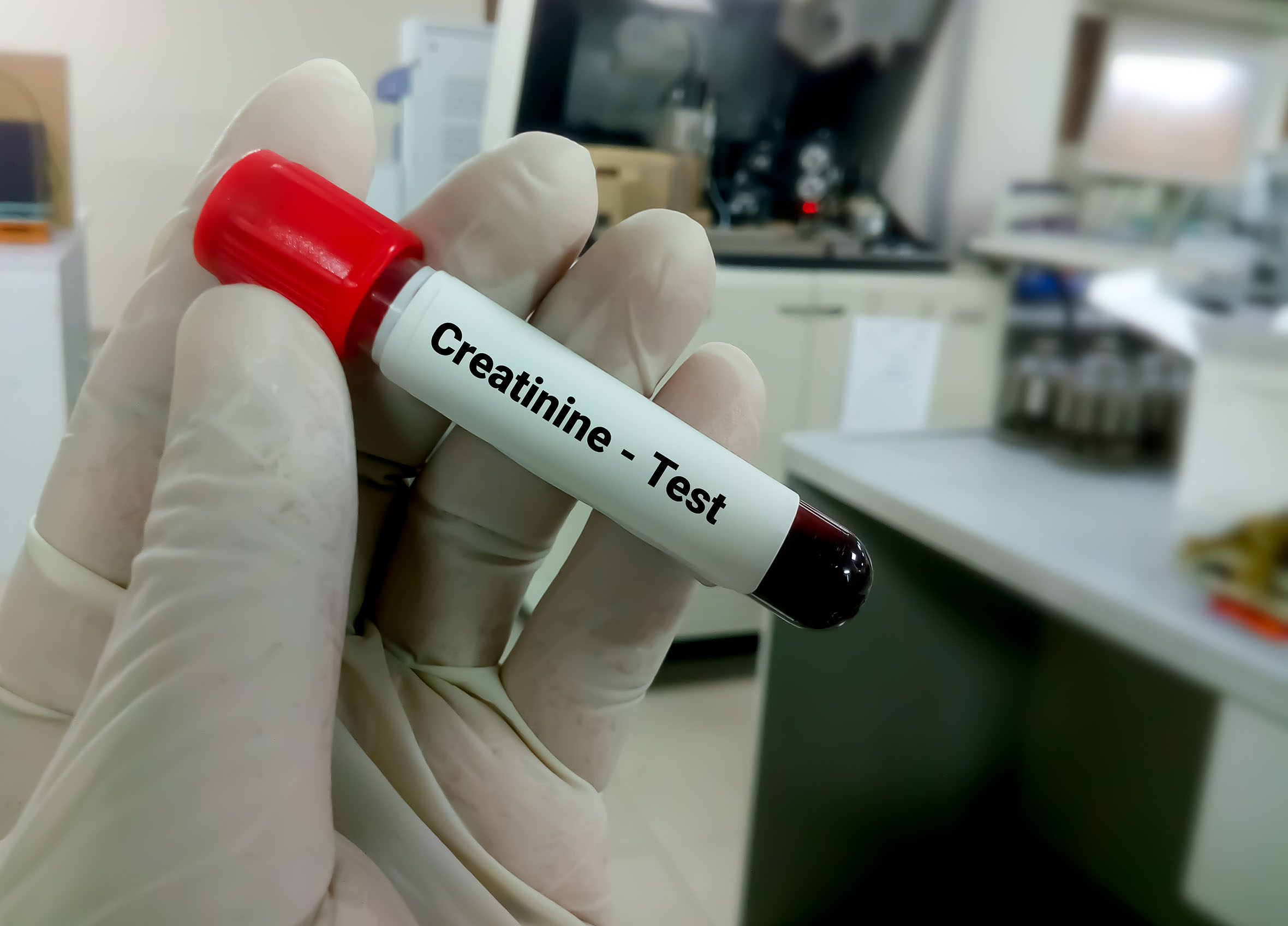 Kreatinin Testi