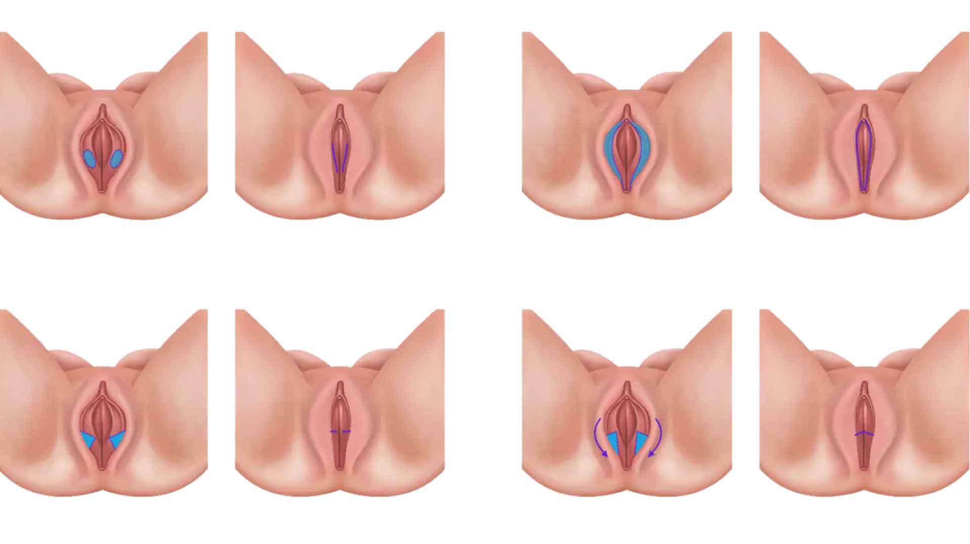 Labioplasti (İç Dudak Estetiği)