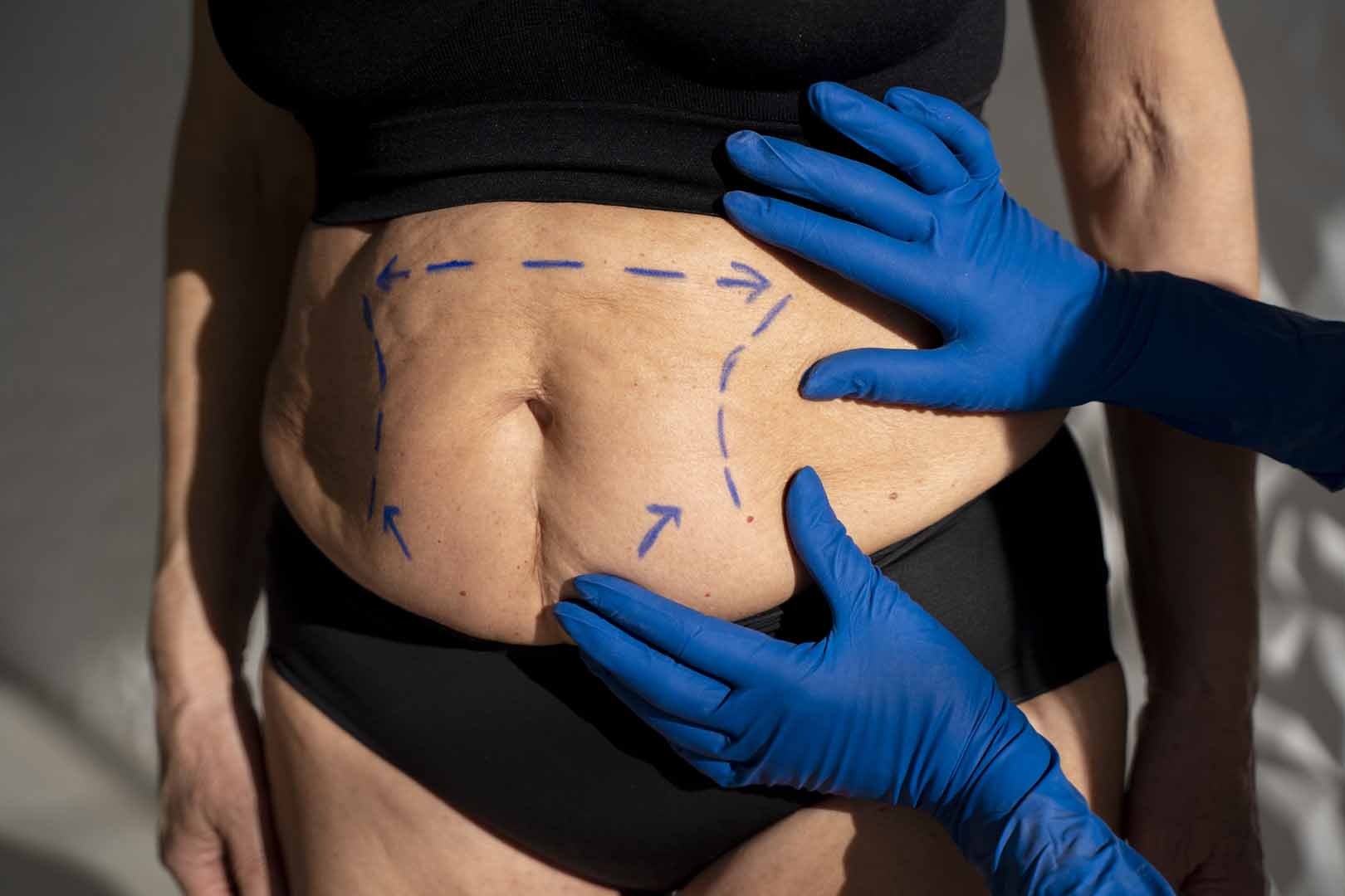 Liposuction (Yağ Alma Cerrahisi)