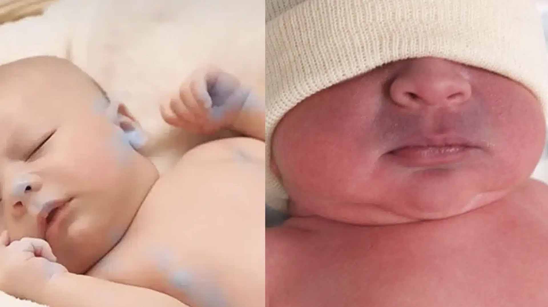 Mavi Bebek Hastalığı (Fallot Tetralojisi) Ameliyatı