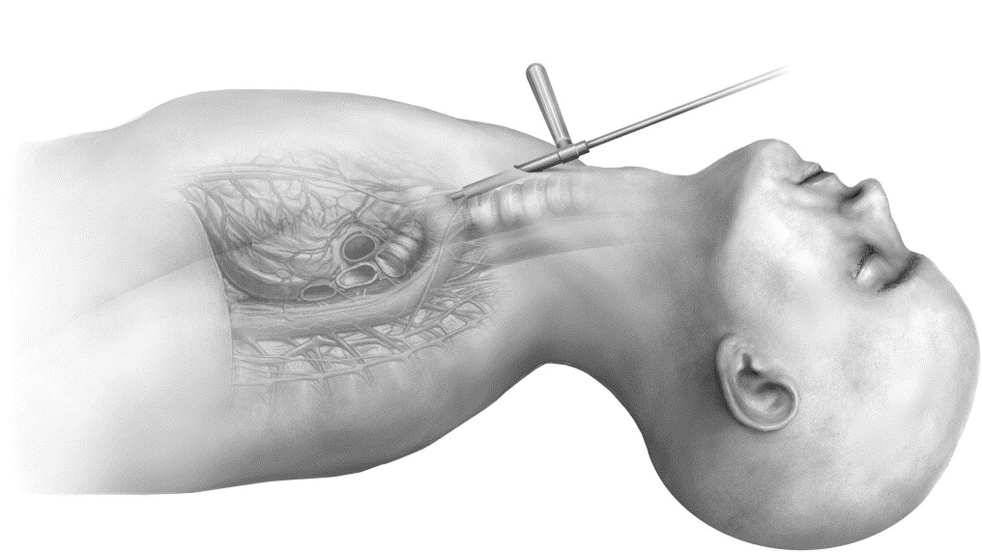 Mediastinoskopi