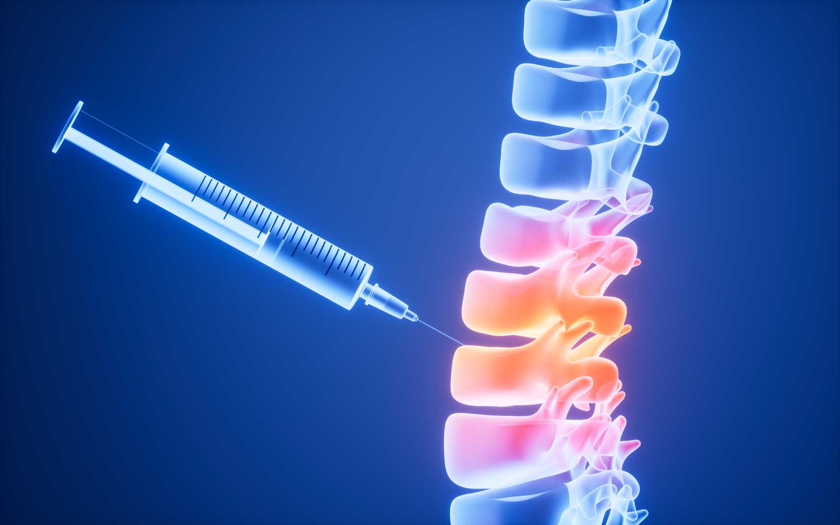 Spinal Enjeksiyon (Omurga Nokta Atışı Tedavisi)