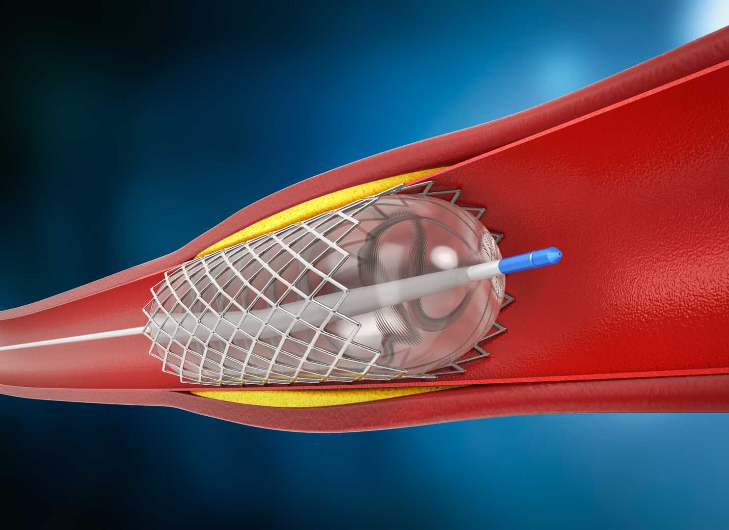 Stent Uygulamaları