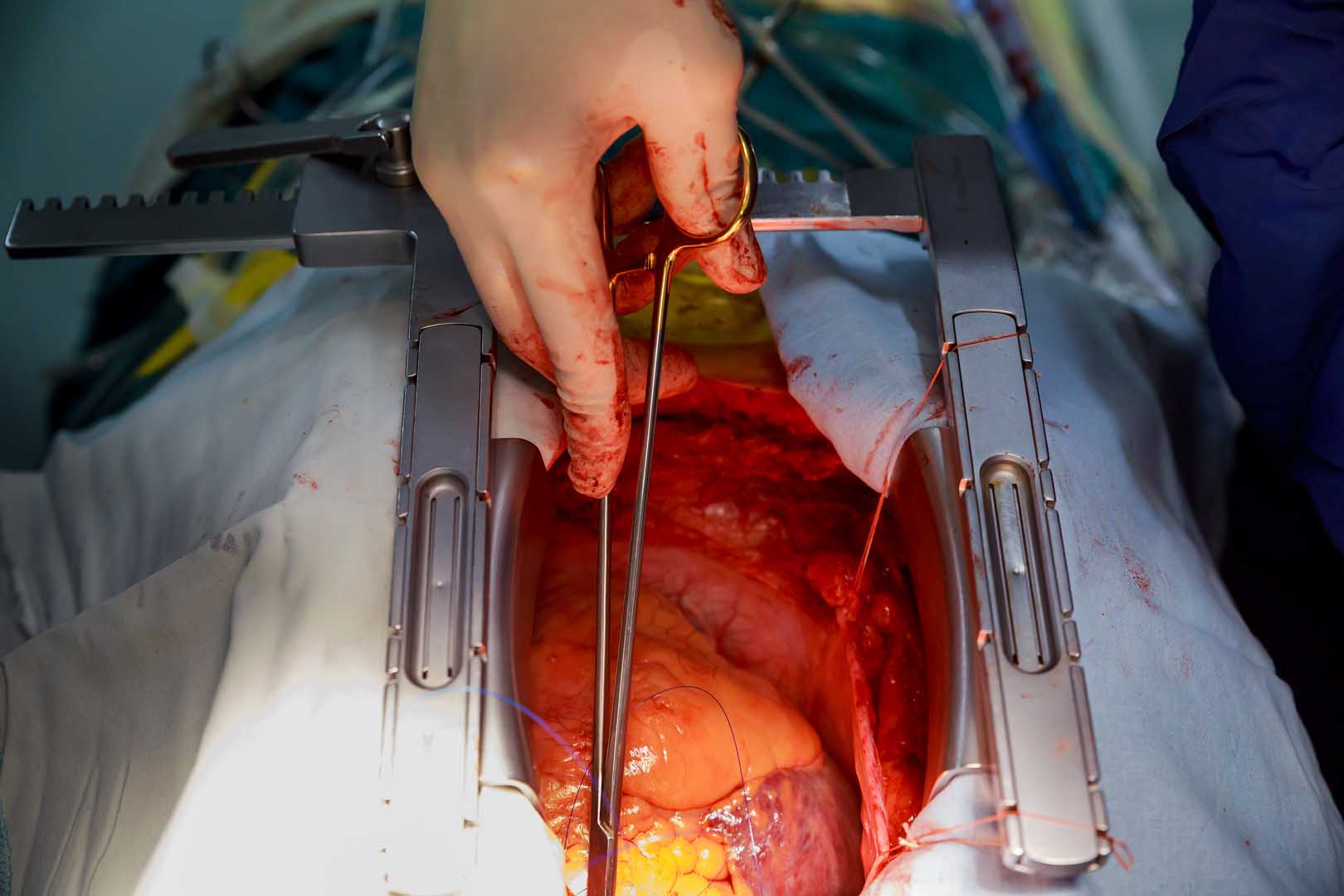 TAVI (Transkateter Aort Kapak İmplantasyonu)
