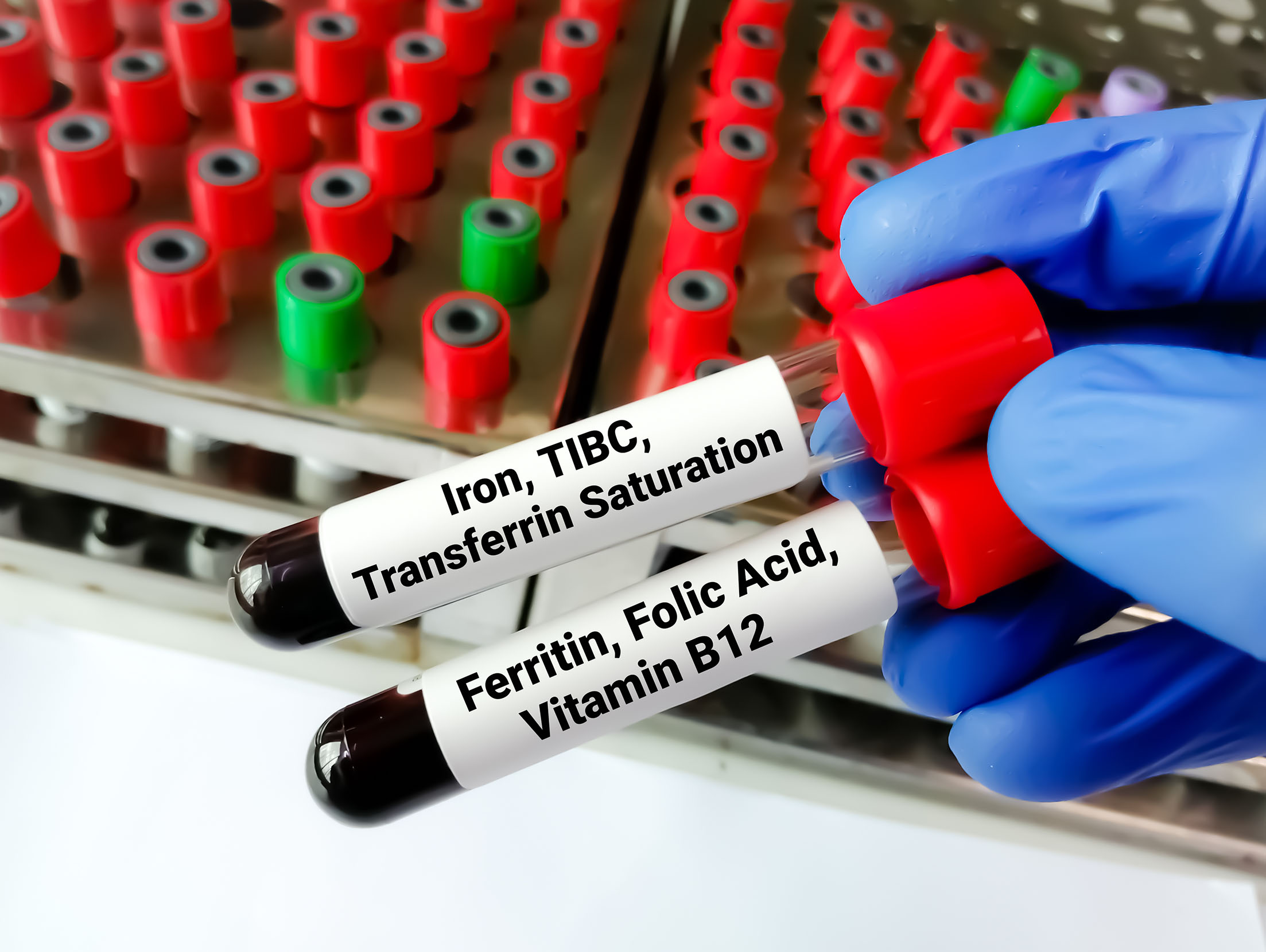 Transferrin Satürasyonu Testi