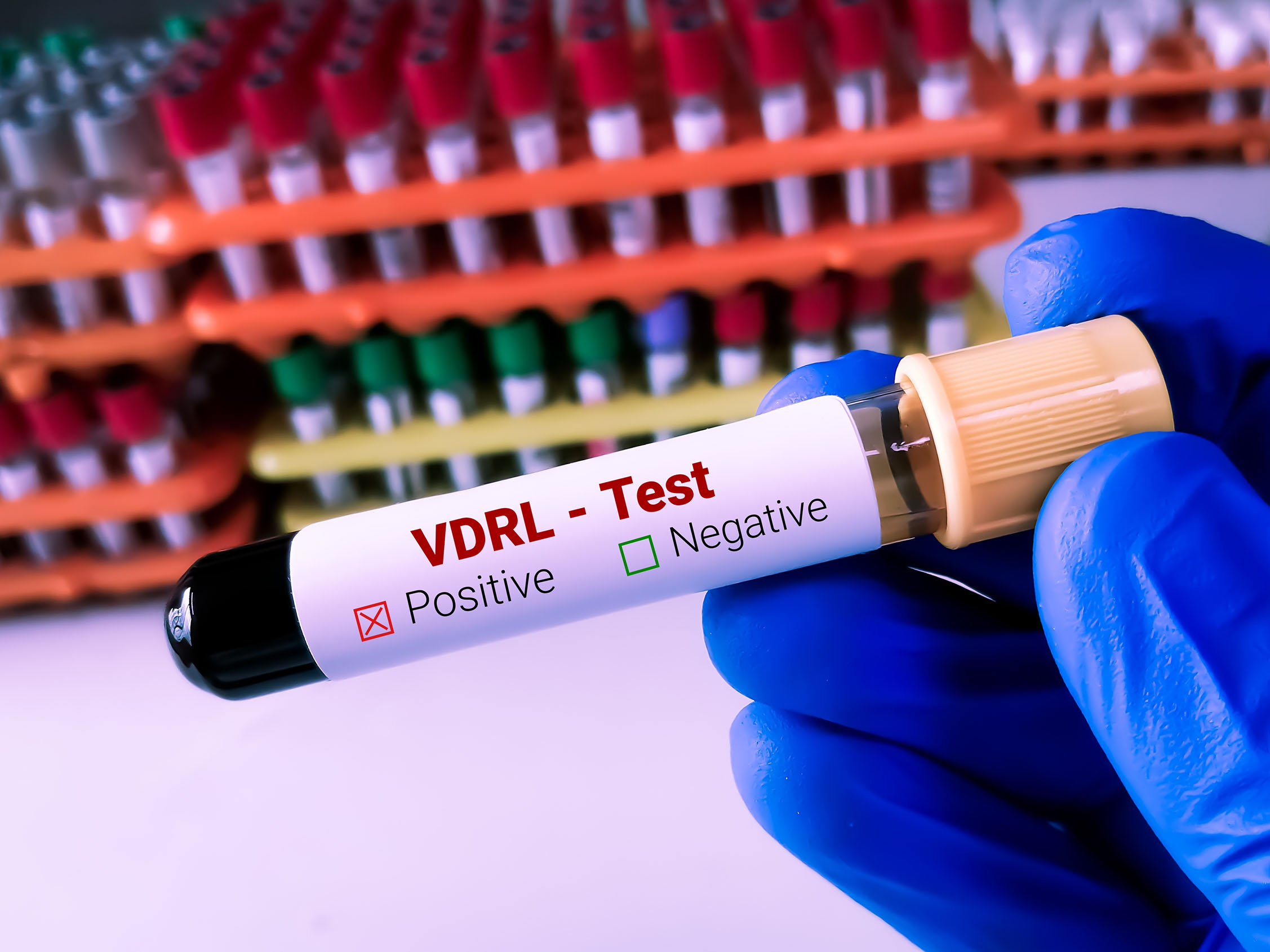 VDRL Testi